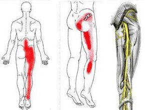 坐骨神经头条,揭秘疼痛之源，守护健康之道